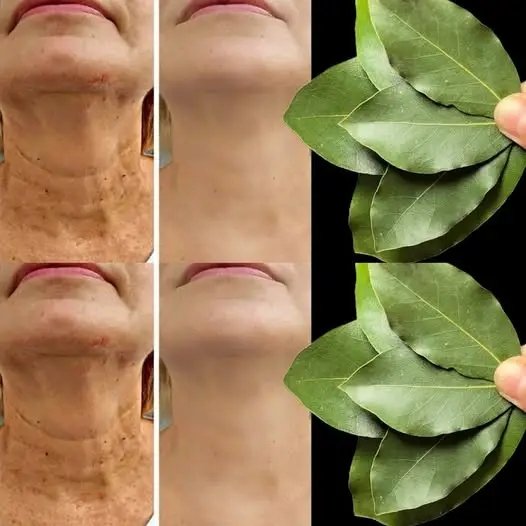 Is Bay Leaf 100,000 Times More Effective Than Botox? | Natural Wrinkle Remover, Even at 70!