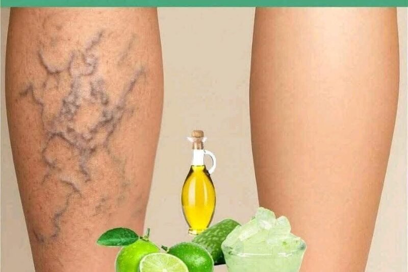 My Grandmother Treated Varicose Veins With Just 3 Kitchen Ingredients